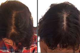 Lee más sobre el artículo Antes/Después tratamiento alopecia femenina
